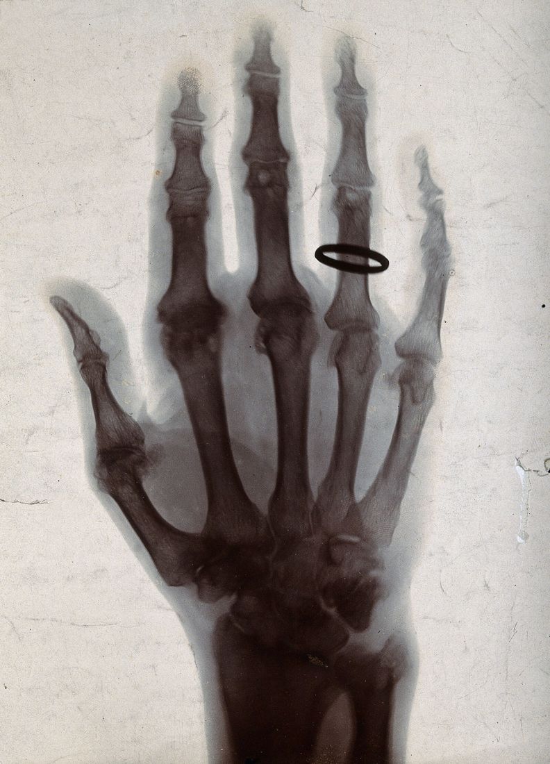 Radiographie ancienne d'une main baguée